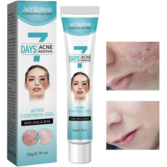 Crema tratamiento acné mascarilla facial
